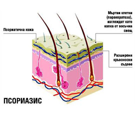 Лечение на псориазис без хормони